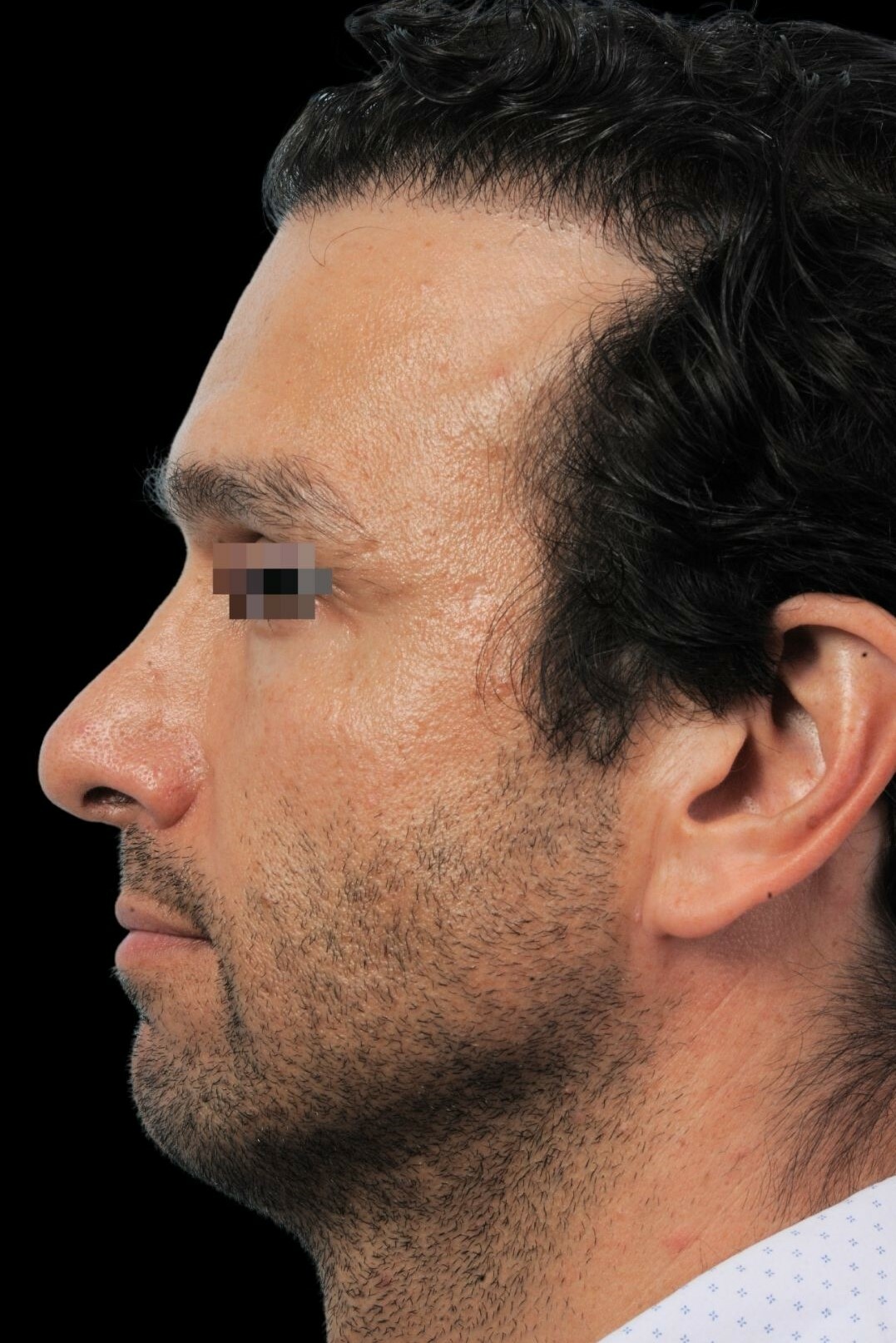 Photo of the patient’s before the Rhinoplasty Patient 3