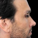 Thumbnail photo of the patient’s after the Rhinoplasty Patient 3