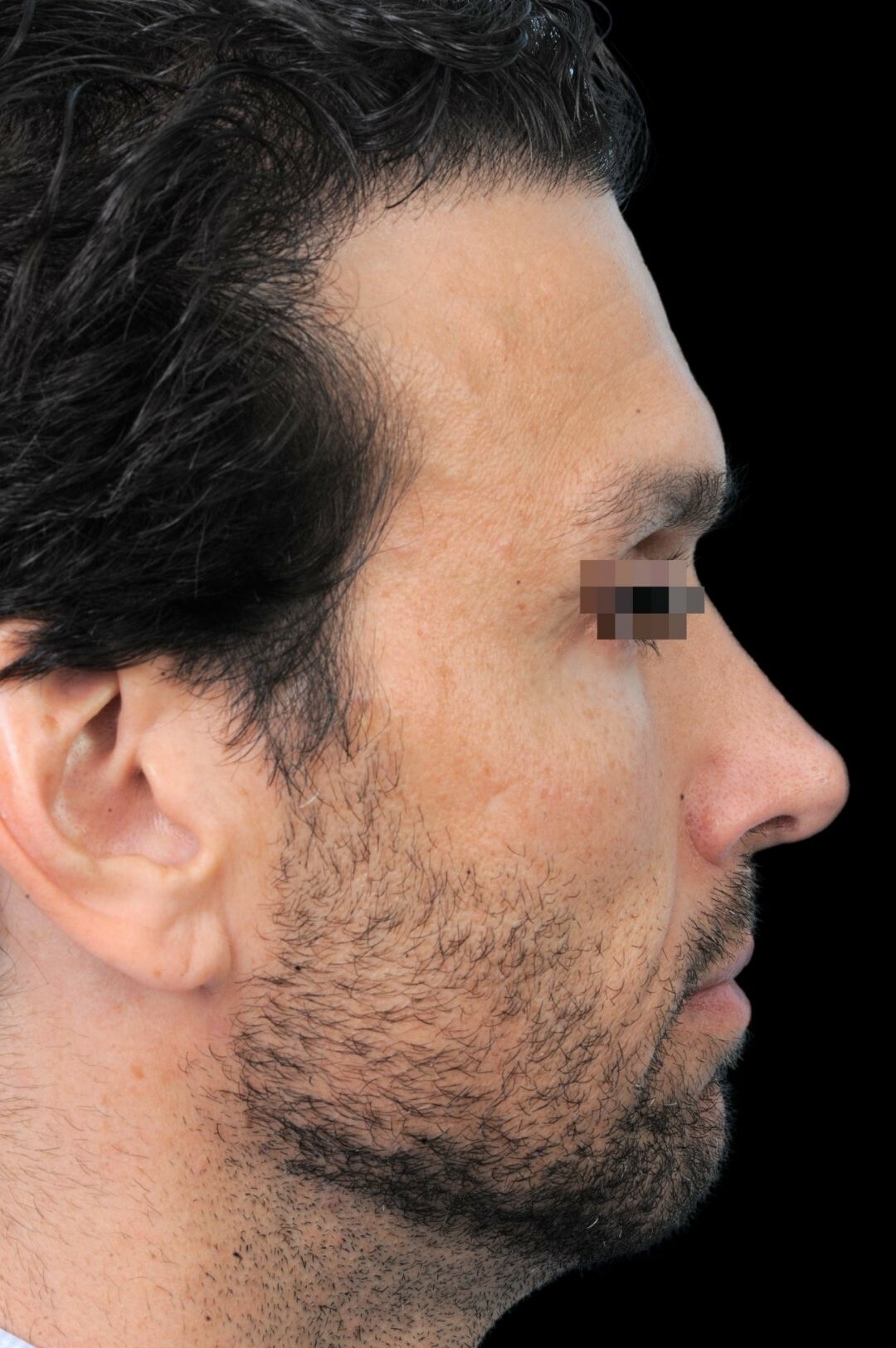 Photo of the patient’s face after the Rhinoplasty surgery. Patient 3 - Set 1
