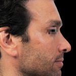 Thumbnail photo of the patient’s before the Rhinoplasty Patient 3