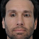 Thumbnail photo of the patient’s after the Rhinoplasty Patient 3