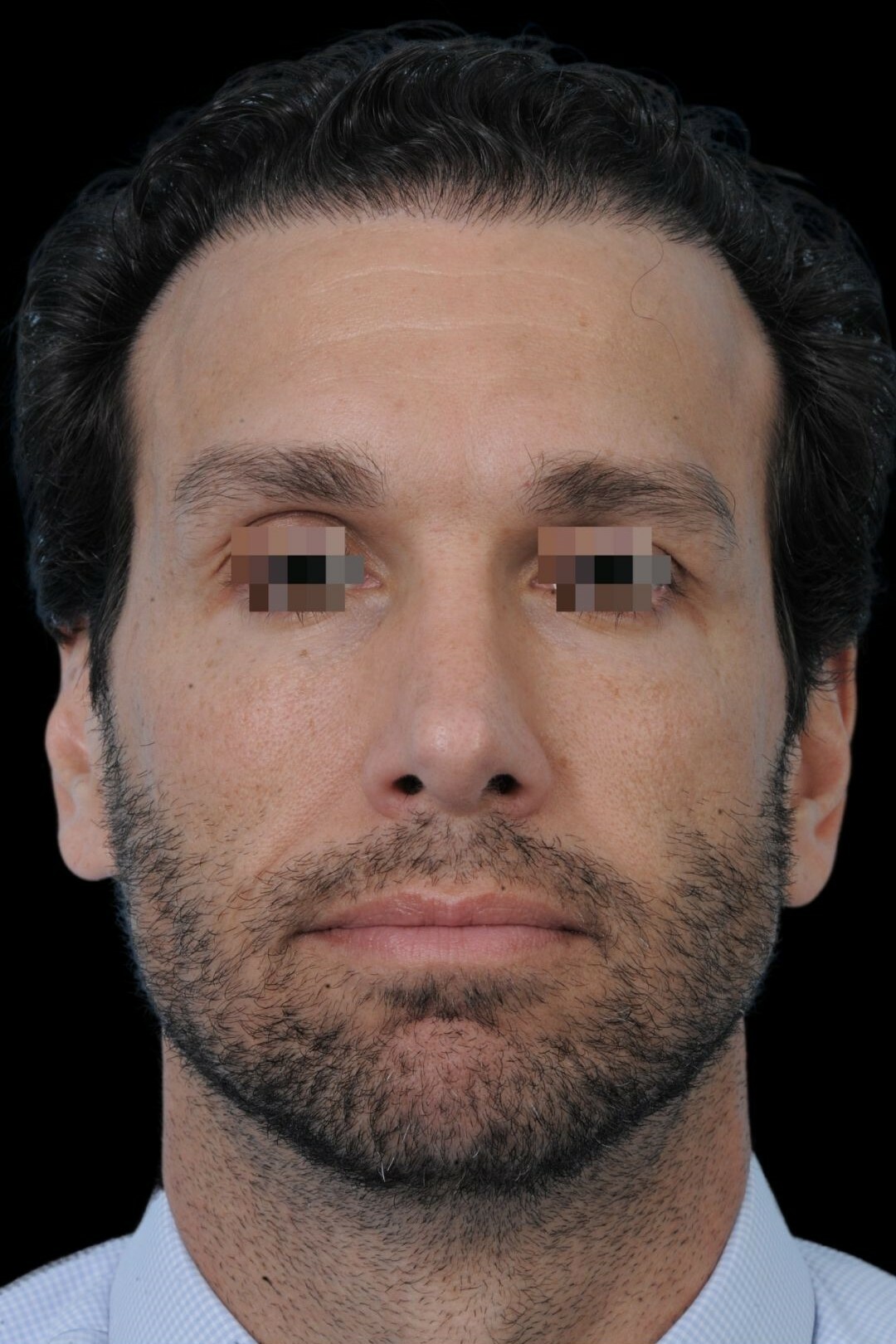 Photo of the patient’s after the Rhinoplasty Patient 3