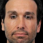 Thumbnail photo of the patient’s before the Rhinoplasty Patient 3