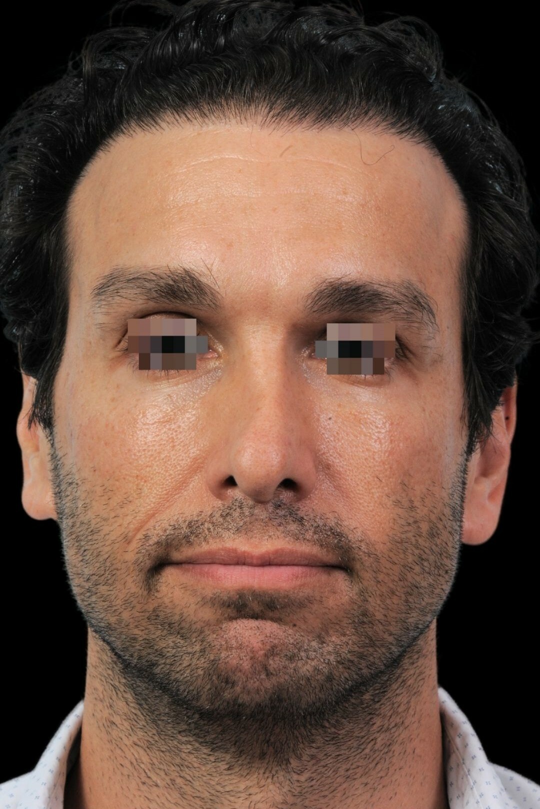 Photo of the patient’s before the Rhinoplasty Patient 3