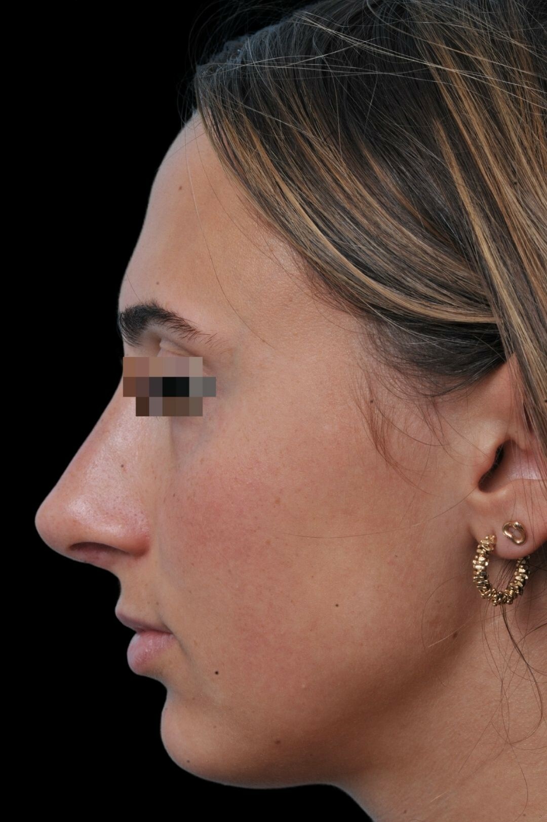 Photo of the patient’s face after the Rhinoplasty surgery. Patient 4 - Set 2