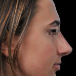 Photo of the patient’s face after the Rhinoplasty surgery. Patient 4 - Set 1