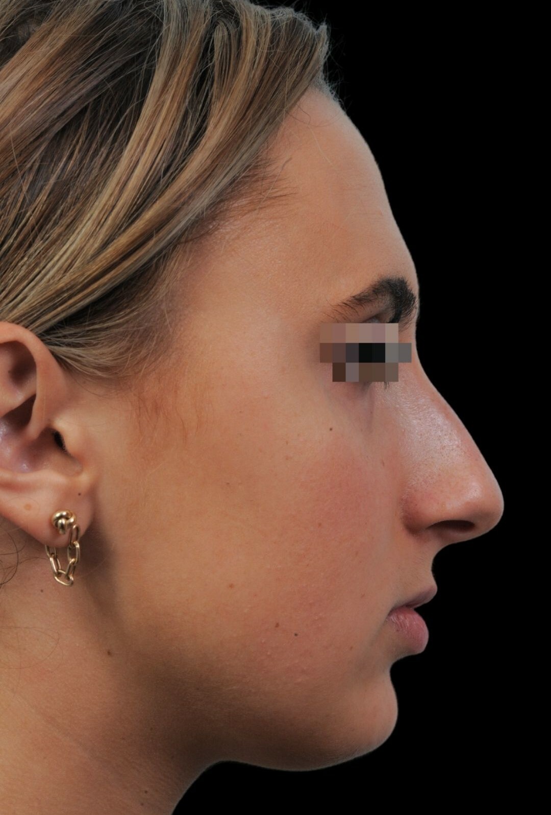 Photo of the patient’s face before the Rhinoplasty surgery. Patient 4 - Set 1