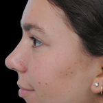 Thumbnail photo of the patient’s after the Rhinoplasty Patient 5