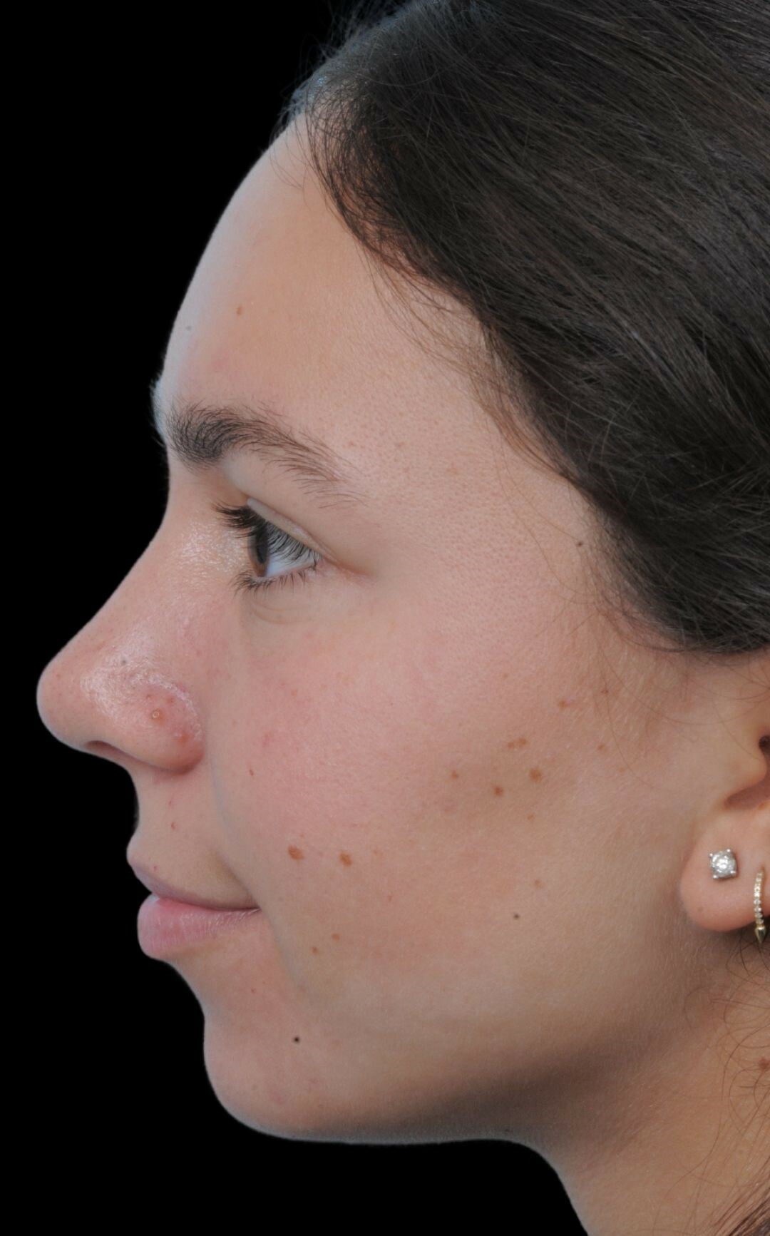 Photo of the patient’s after the Rhinoplasty Patient 5