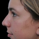 Thumbnail photo of the patient’s before the Rhinoplasty Patient 5