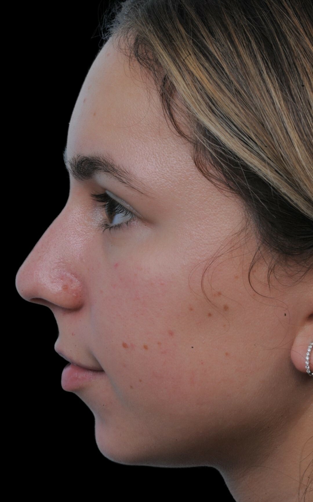 Photo of the patient’s face before the Rhinoplasty surgery. Patient 5 - Set 2