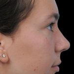 Thumbnail photo of the patient’s after the Rhinoplasty Patient 5