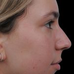 Thumbnail photo of the patient’s before the Rhinoplasty Patient 5