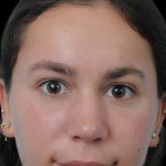 Thumbnail photo of the patient’s after the Rhinoplasty Patient 5