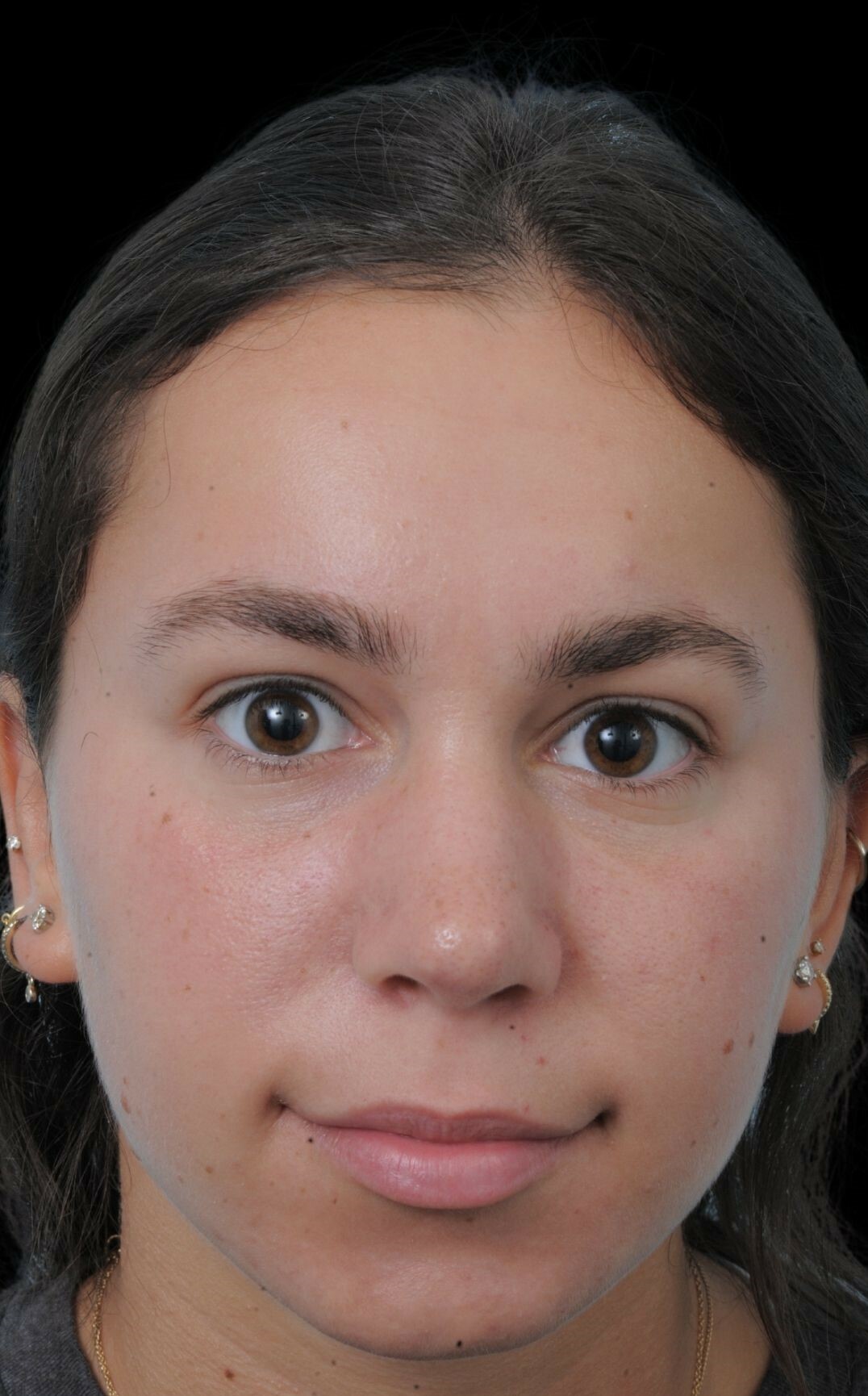 Photo of the patient’s after the Rhinoplasty Patient 5