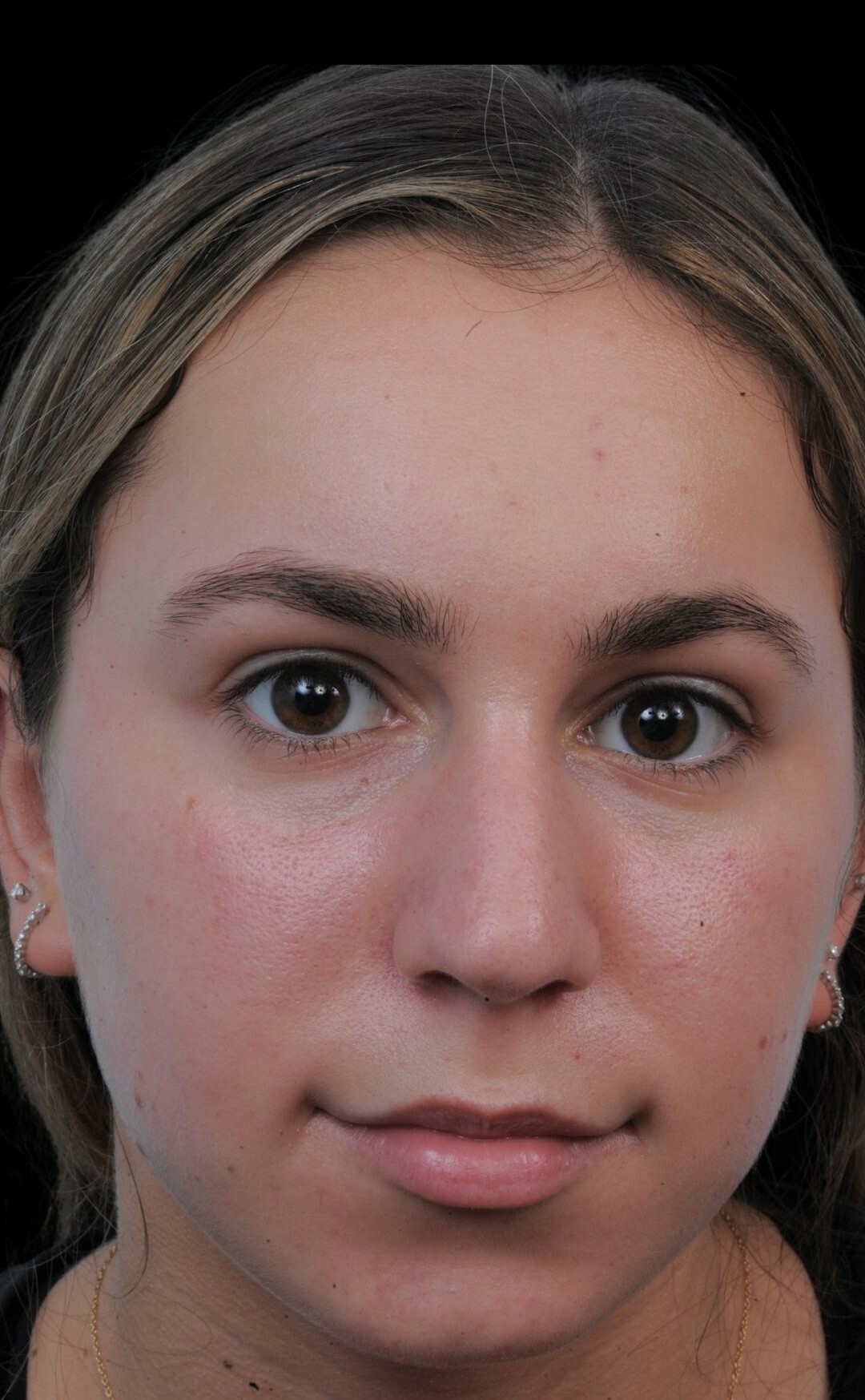 Photo of the patient’s before the Rhinoplasty Patient 5