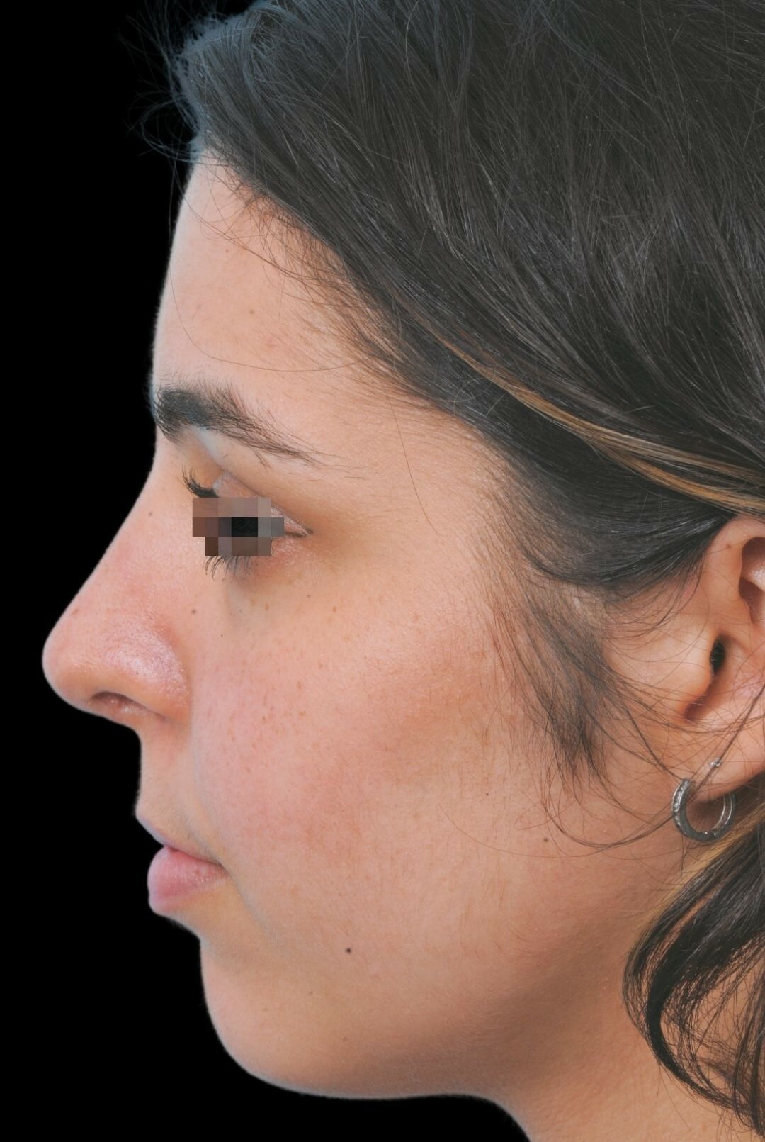 Photo of the patient’s face after the Rhinoplasty surgery. Patient 6 - Set 2