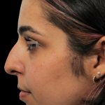 Thumbnail photo of the patient’s before the Rhinoplasty Patient 6