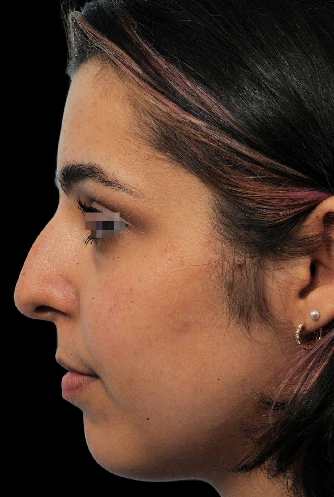 Photo of the patient’s face before the Rhinoplasty surgery. Patient 6 - Set 2