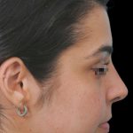 Thumbnail photo of the patient’s after the Rhinoplasty Patient 6