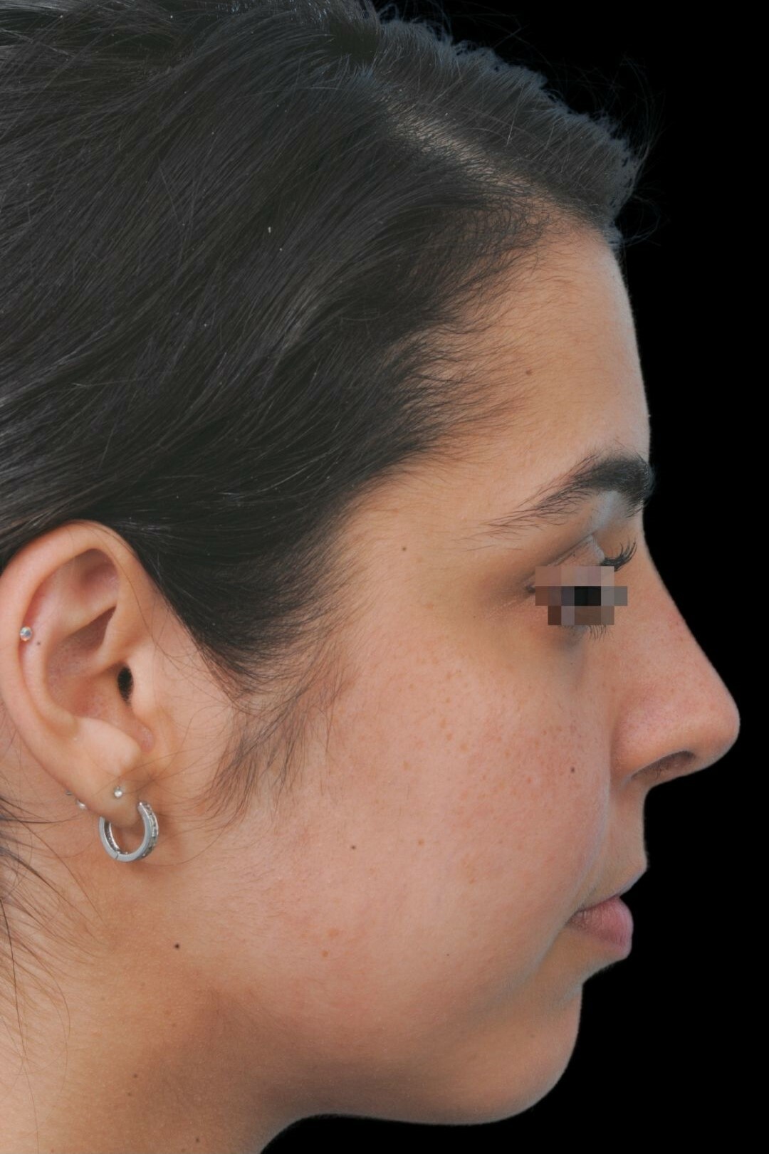 Photo of the patient’s after the Rhinoplasty Patient 6