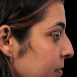 Thumbnail photo of the patient’s before the Rhinoplasty Patient 6