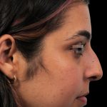 Photo of the patient’s face before the Rhinoplasty surgery. Patient 6 - Set 1