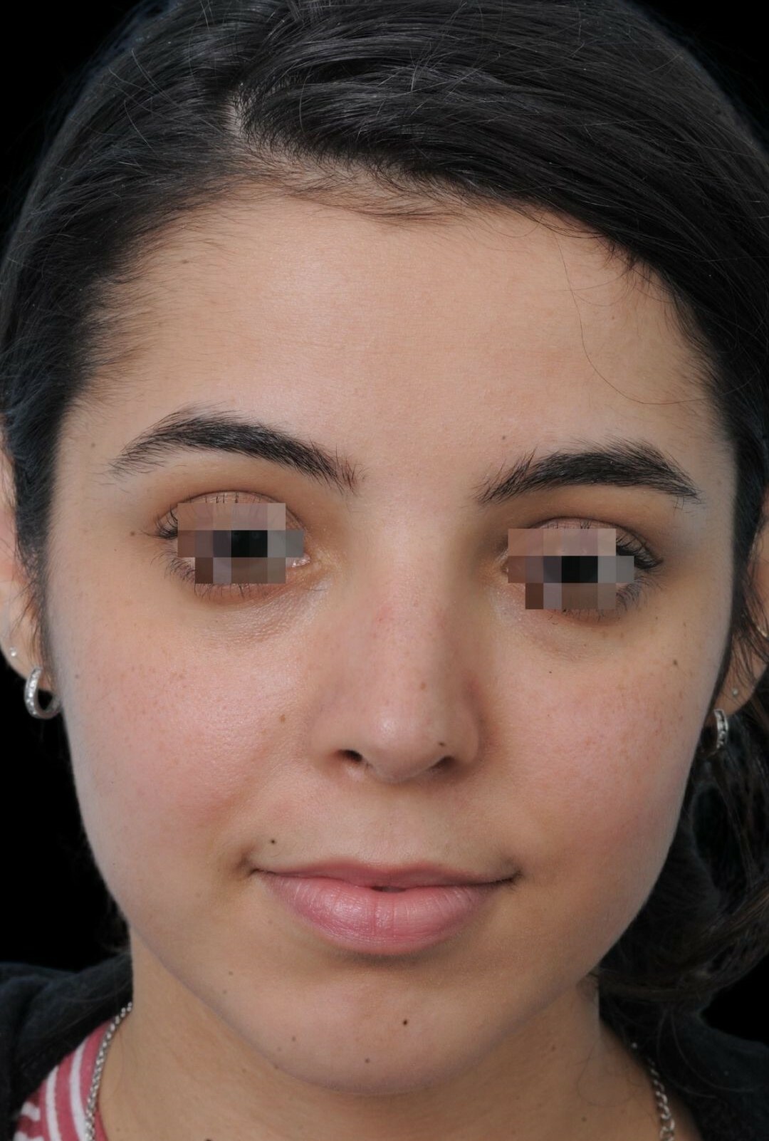 Photo of the patient’s after the Rhinoplasty Patient 6