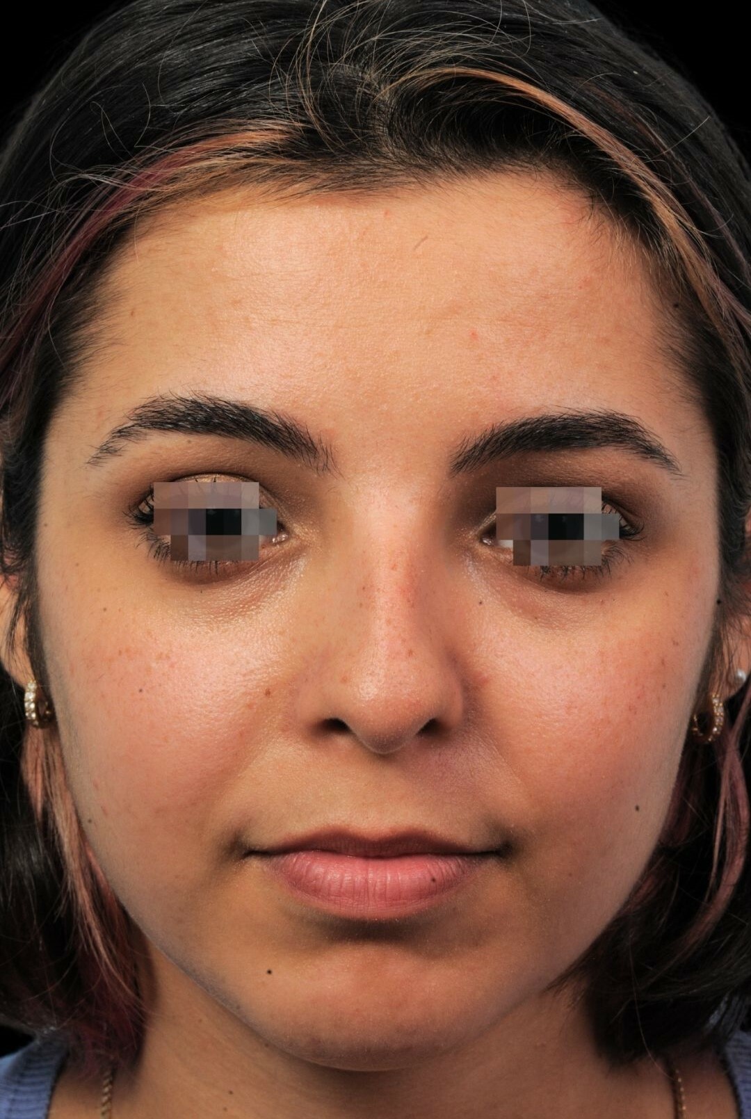 Photo of the patient’s before the Rhinoplasty Patient 6