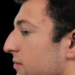 Thumbnail photo of the patient’s before the Rhinoplasty Patient 7