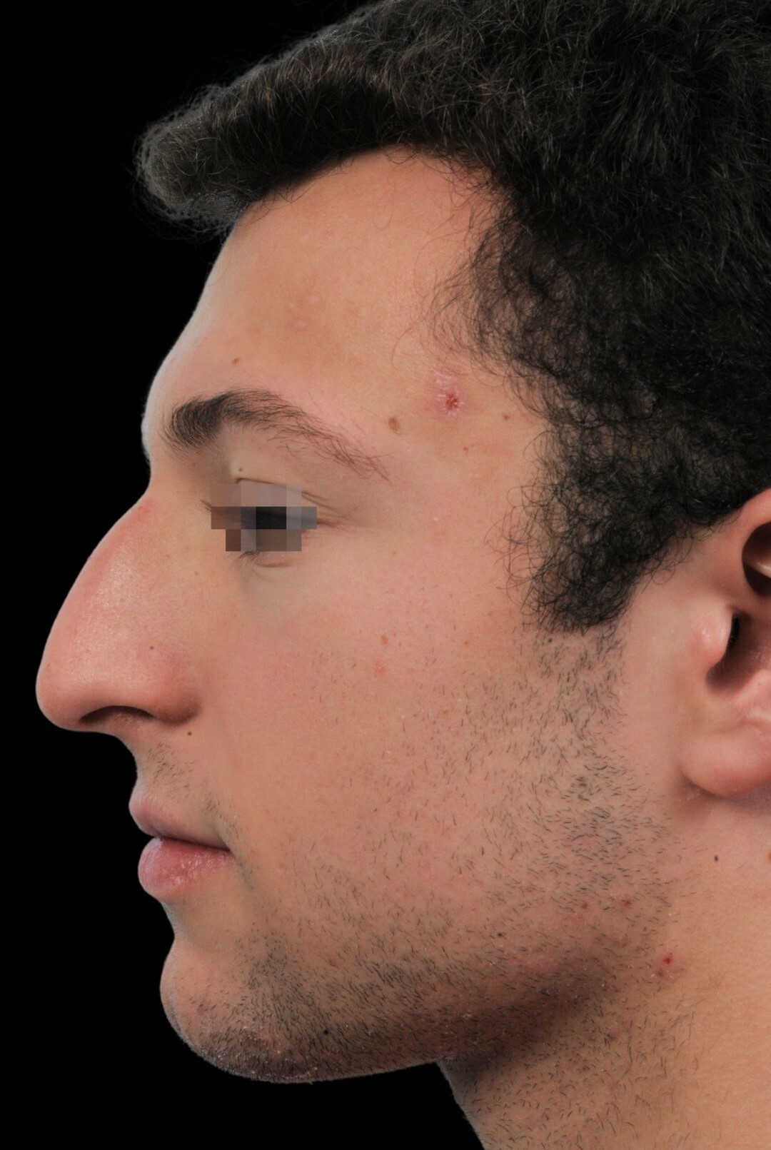 Photo of the patient’s face before the Rhinoplasty surgery. Patient 7 - Set 2