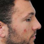 Thumbnail photo of the patient’s after the Rhinoplasty Patient 7