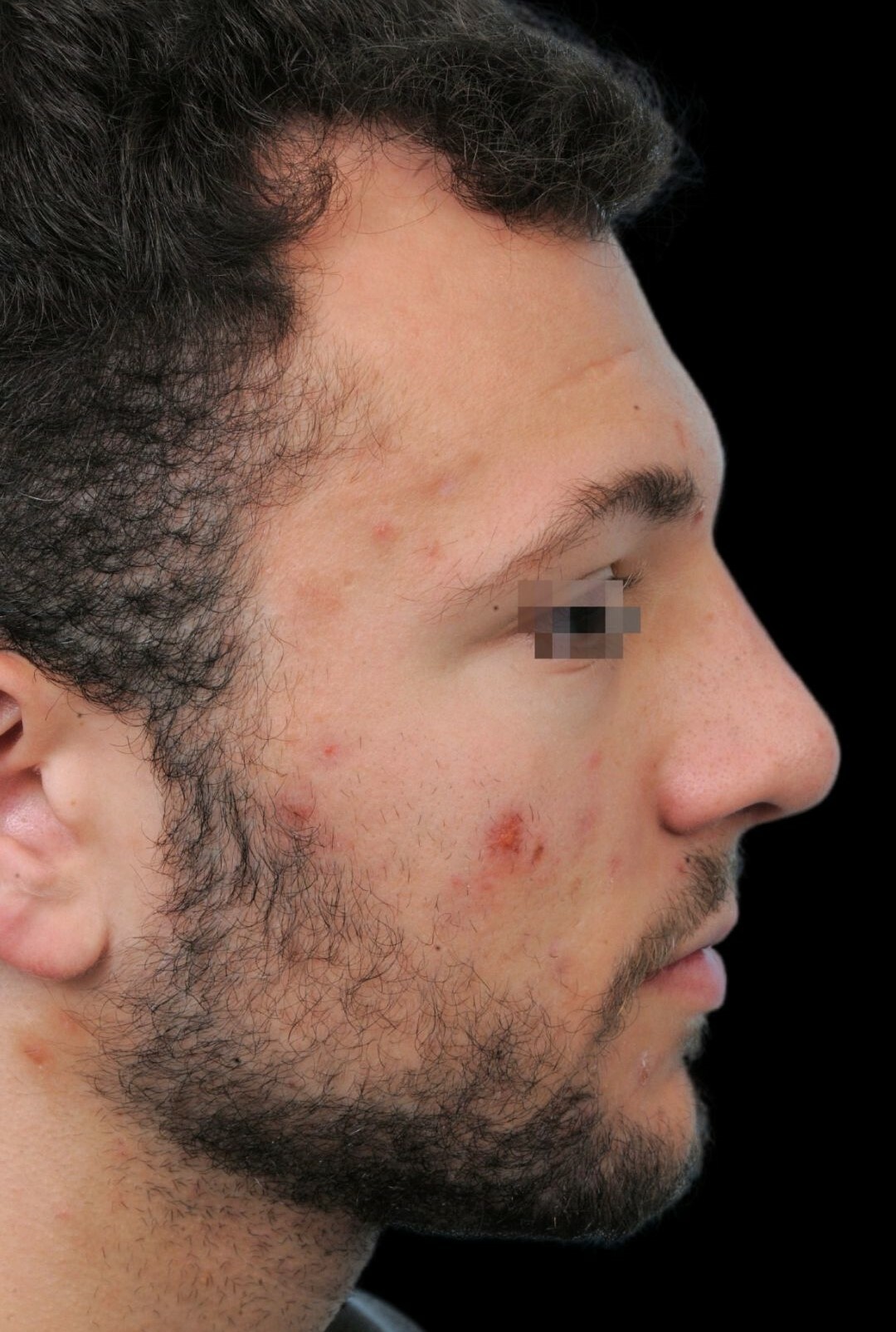 Photo of the patient’s after the Rhinoplasty Patient 7