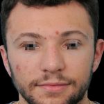 Thumbnail photo of the patient’s after the Rhinoplasty Patient 7