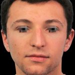 Thumbnail photo of the patient’s before the Rhinoplasty Patient 7