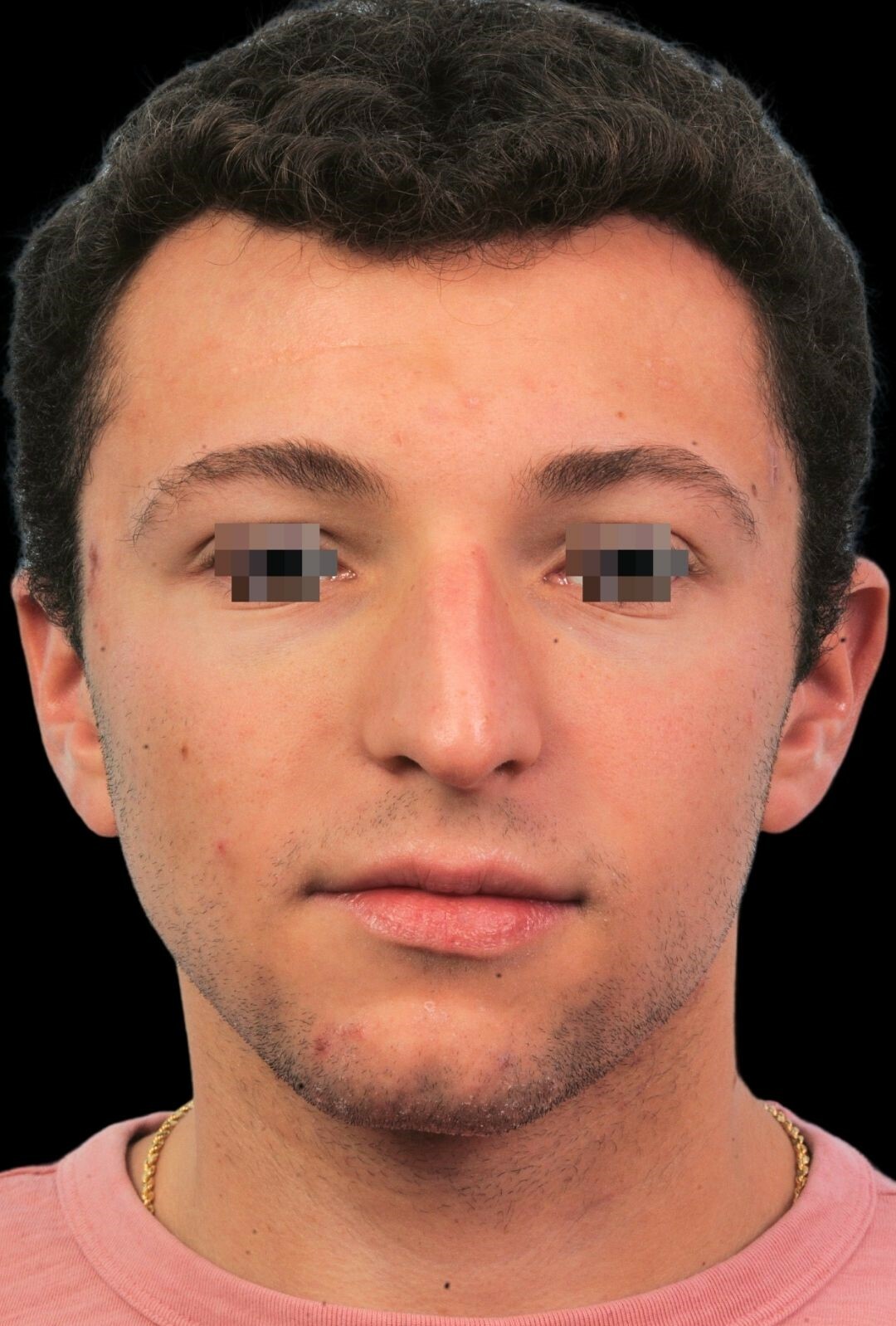 Photo of the patient’s face before the Rhinoplasty surgery. Patient 7 - Set 3