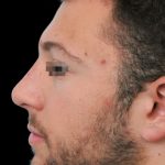 Thumbnail photo of the patient’s after the Rhinoplasty Patient 7