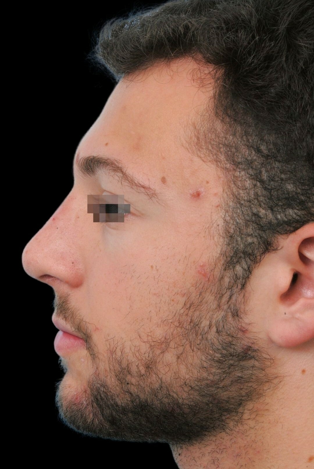 Photo of the patient’s face after the Rhinoplasty surgery. Patient 7 - Set 2