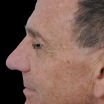 Thumbnail photo of the patient’s after the Rhinoplasty Patient 8