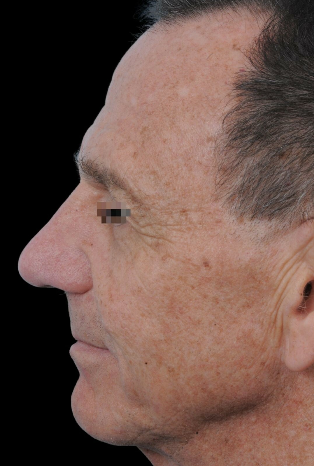 Photo of the patient’s face after the Rhinoplasty surgery. Patient 8 - Set 2
