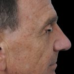 Thumbnail photo of the patient’s after the Rhinoplasty Patient 8