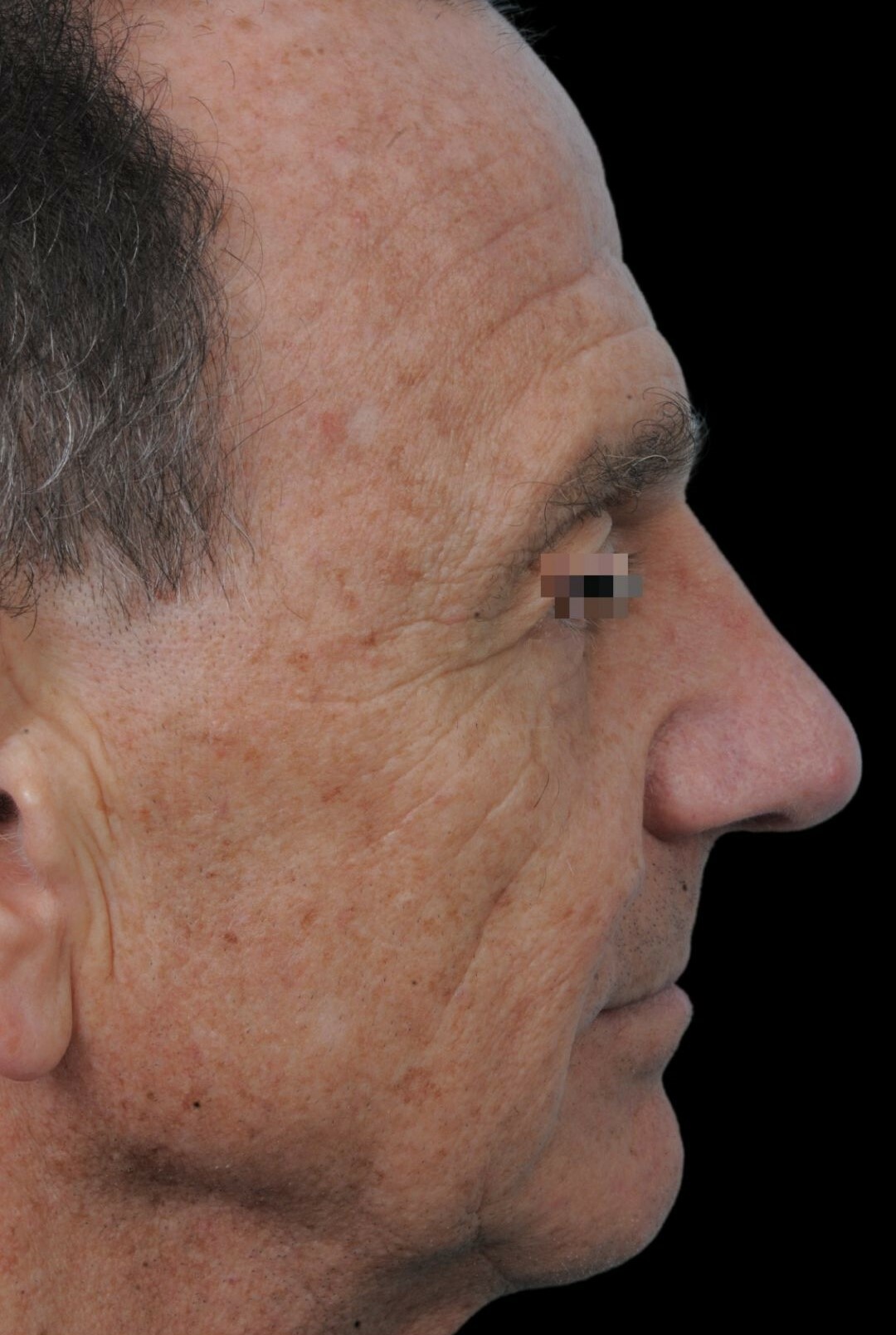 Photo of the patient’s after the Rhinoplasty Patient 8