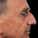 Thumbnail photo of the patient’s before the Rhinoplasty Patient 8