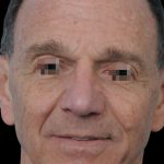 Thumbnail photo of the patient’s after the Rhinoplasty Patient 8