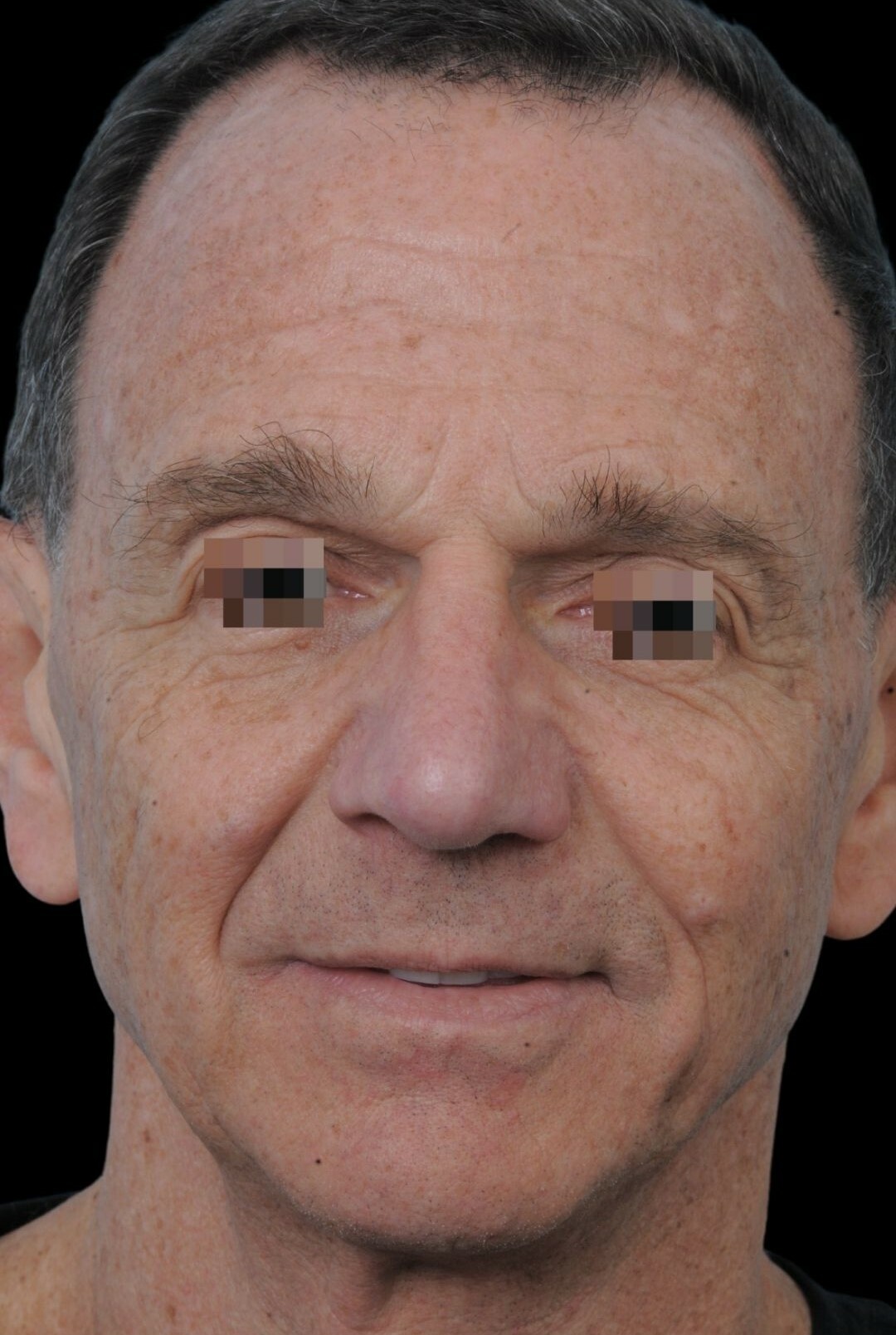 Photo of the patient’s after the Rhinoplasty Patient 8