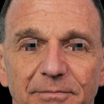 Thumbnail photo of the patient’s before the Rhinoplasty Patient 8