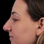 Thumbnail photo of the patient’s after the Rhinoplasty Patient 21