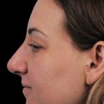 Photo of the patient’s face after the Rhinoplasty surgery. Patient 21 - Set 1