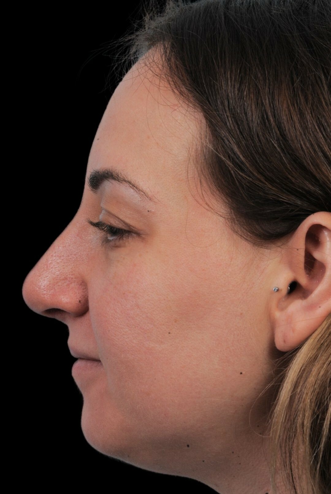 Photo of the patient’s face after the Rhinoplasty surgery. Patient 21 - Set 1