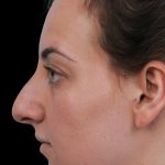Photo of the patient’s face before the Rhinoplasty surgery. Patient 21 - Set 1